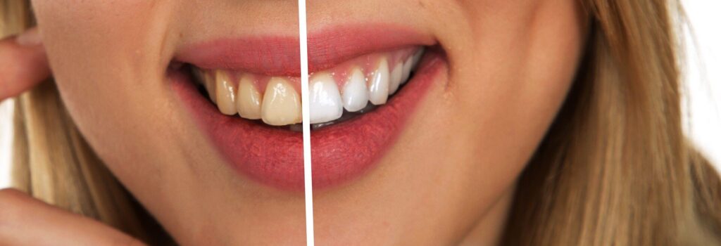 6 Best teeth whitening ways to try at home