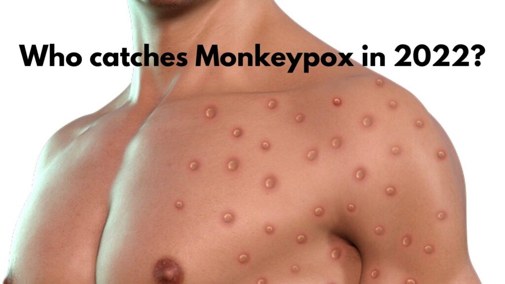 Who catches Monkeypox in 2022